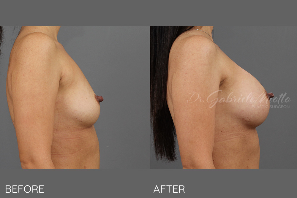 BREAST AUGMENTATION WITH SILICONE GEL, SUBMUSCULAR TRANSAXILLARY (NO BREAST SCARS)