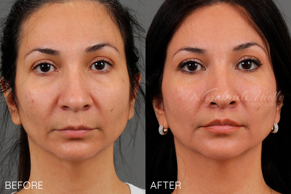 Facelift, necklift, blepharoplasty, brow lift, fat transfer to the face
