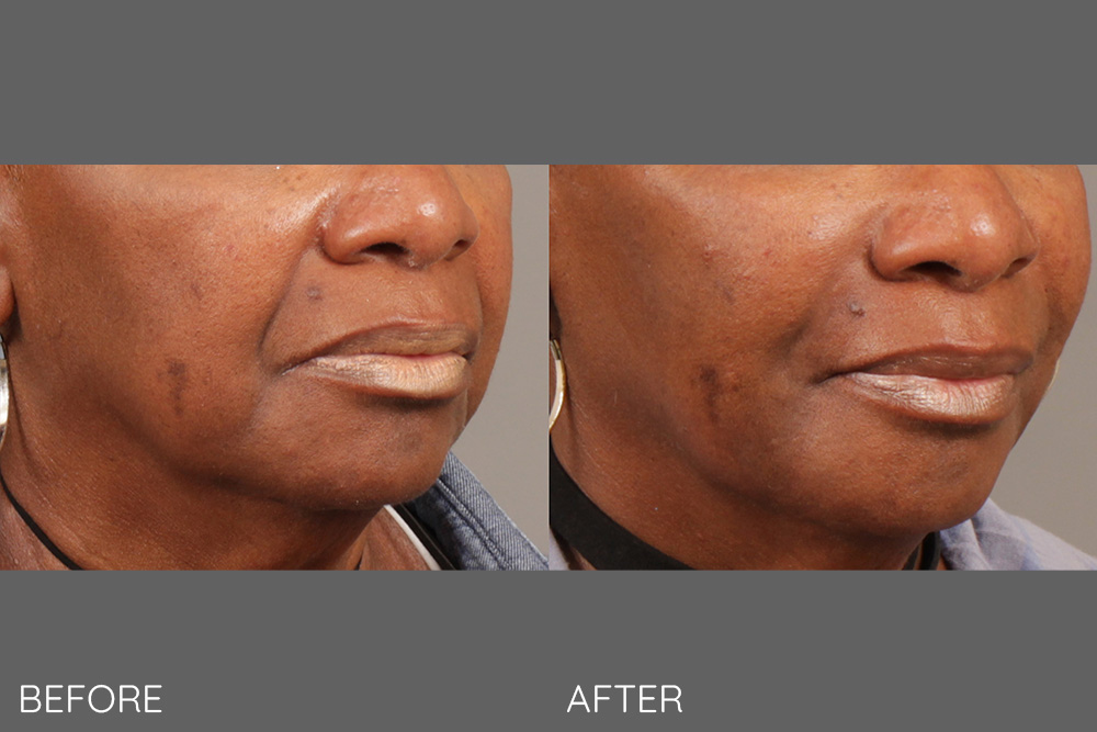 Fillers to nasolabial folds and marionette lines