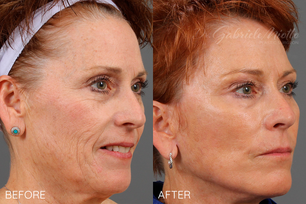 Deep Plane Facelift, neck lift, blepharoplasty, brow lift, fat transfer to the face