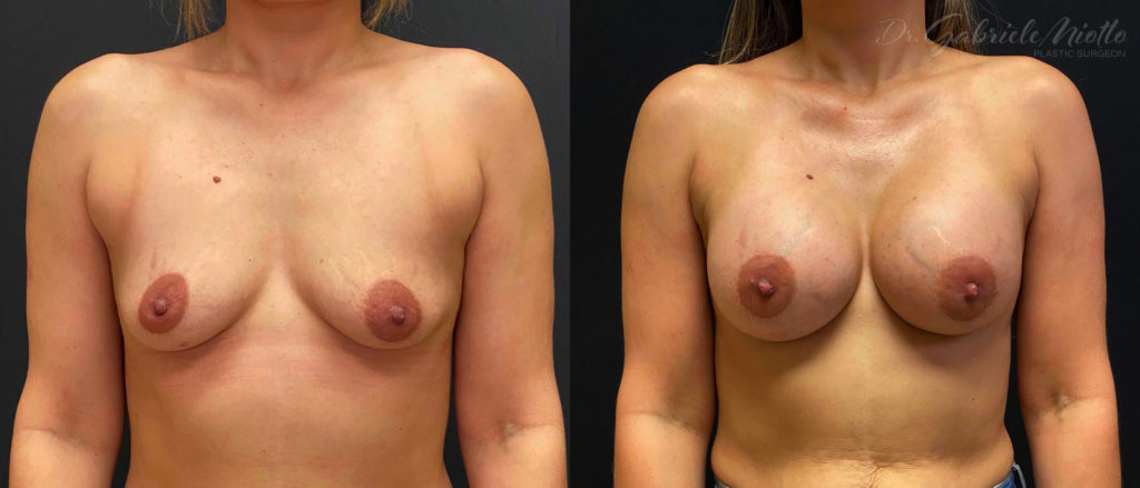 Breast Augmentation Before & After Photo - Dr. Miotto
