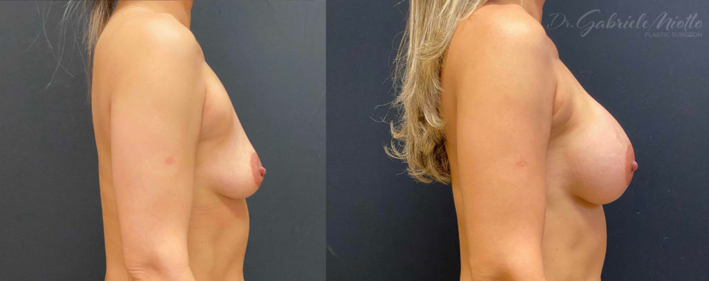 Breast Augmentation Before & After Photo - Dr. Miotto