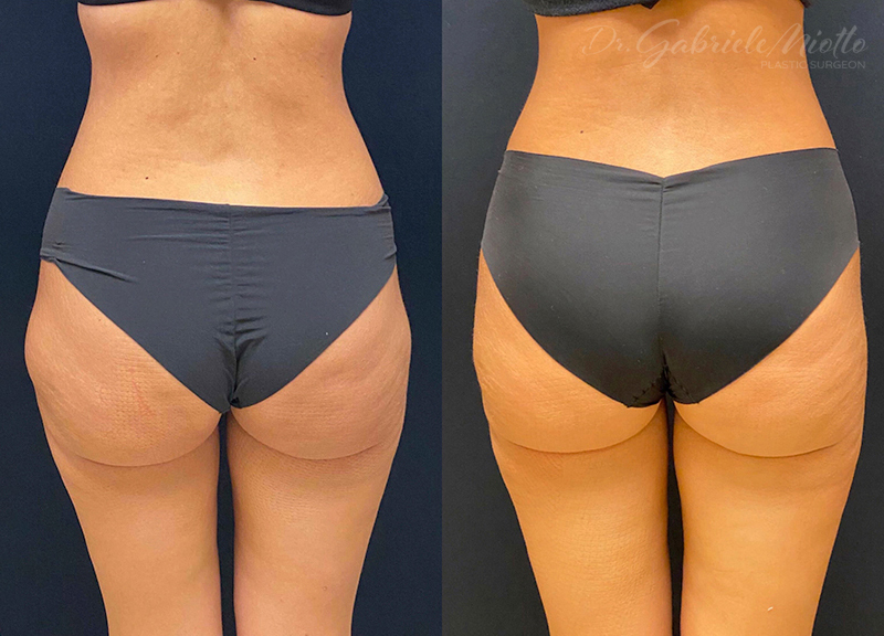 Liposuction Before & After Photo - Dr. Miotto