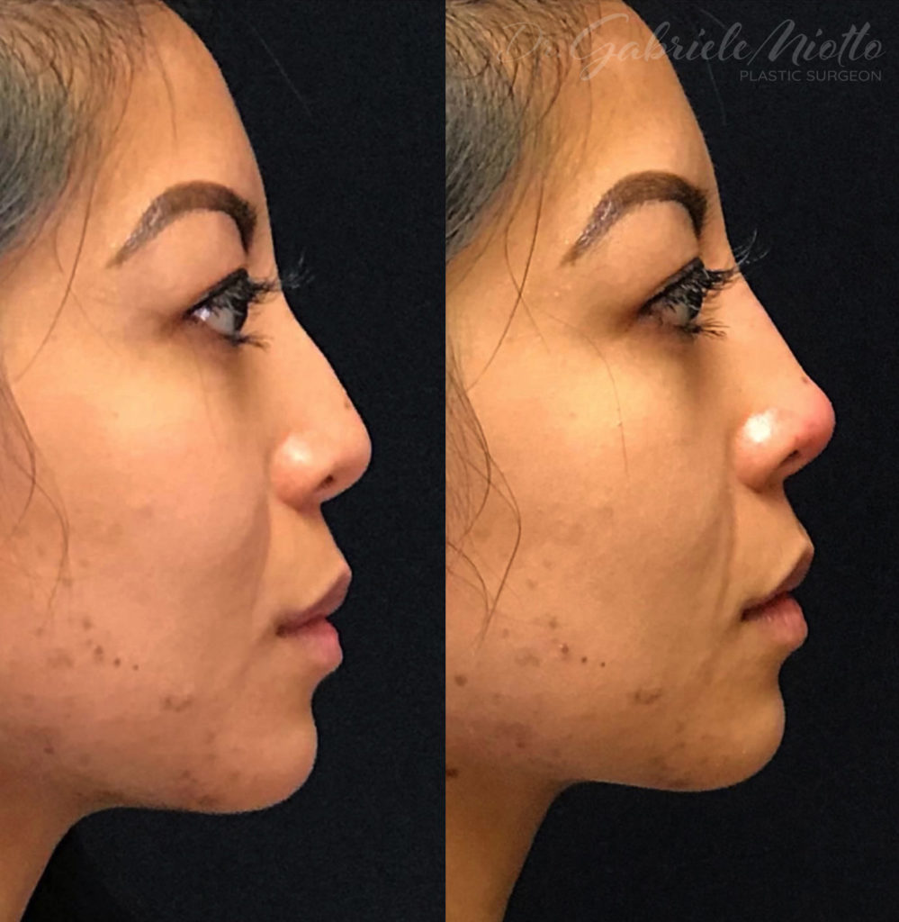 Non-Surgical (Liquid) Rhinoplasty Before & After Photo - Dr. Miotto 