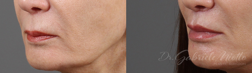 Lip Lift surgery before and after photos. Lip Lift performed by Dr. Miotto in Atlanta, GA.
