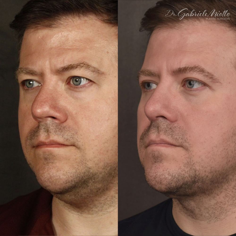Neck Lipo Before & After Photo - Dr. Miotto
