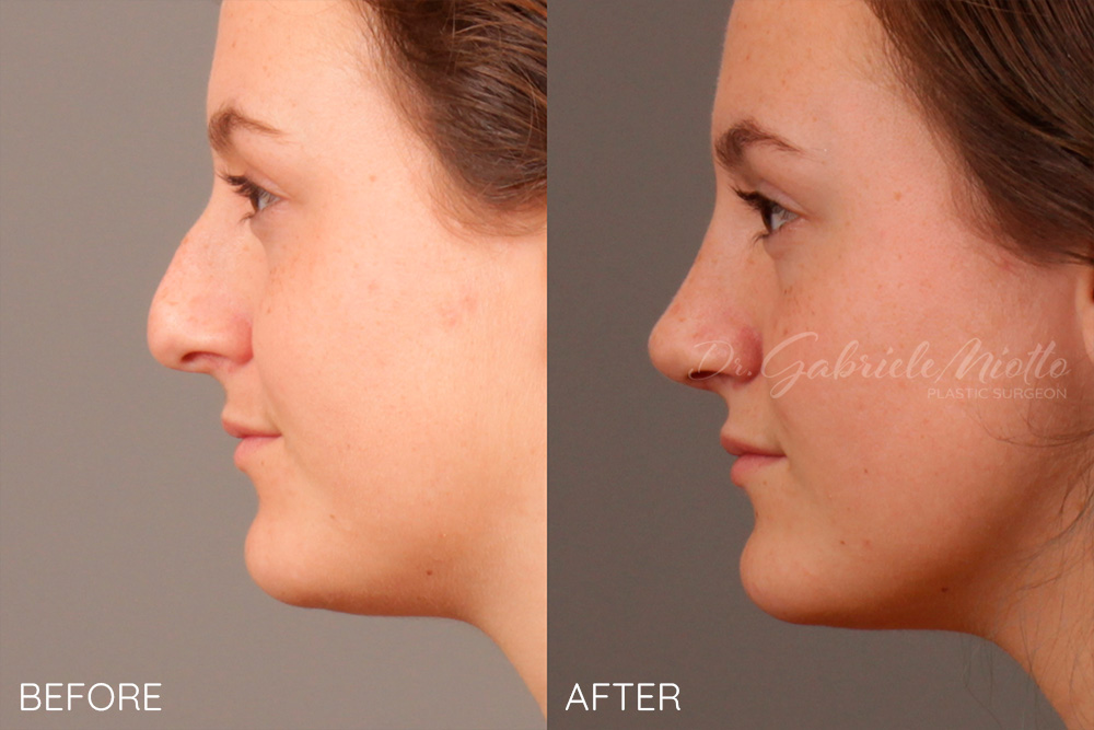 Atlanta Open Rhinoplasty (Nose Job) and Septoplasty Before and After Photo. Surgery performed in Atlanta, GA by Dr. Miotto