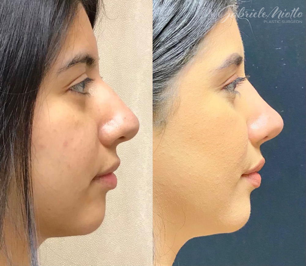 Atlanta Rhinoplasty (Nose Job) Before and After Photo. Surgery performed in Atlanta, GA by Dr. Miotto