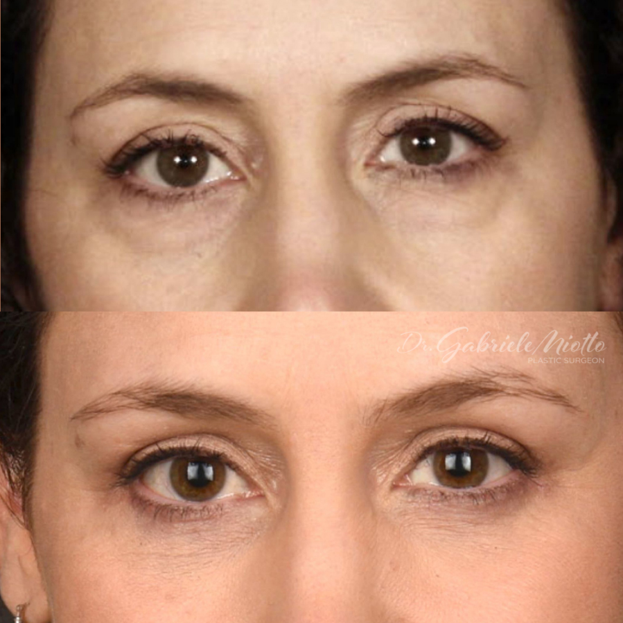Eyelid Surgery (Blepharoplasty) in Atlanta, GA. Eyelid Surgery performed by Dr. Miotto