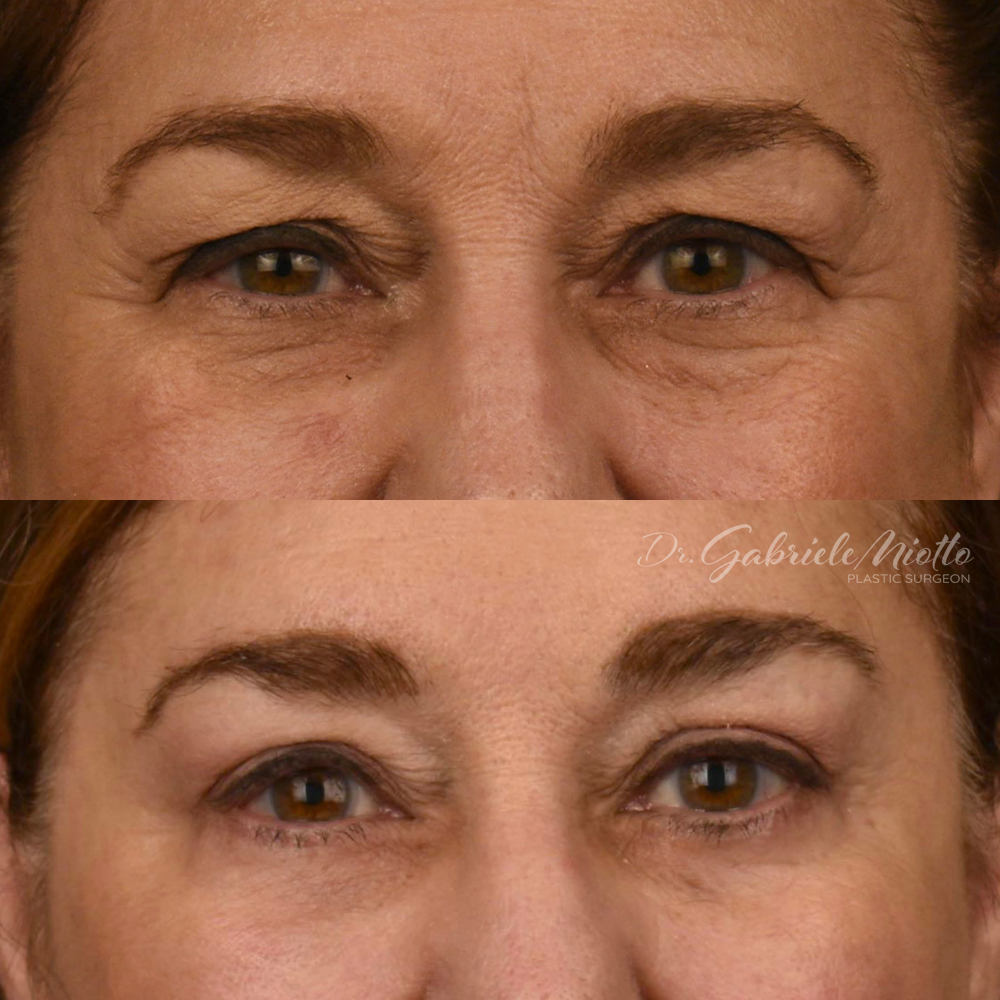 Eyelid Surgery (Blepharoplasty) in Atlanta, GA. Eyelid Surgery performed by Dr. Miotto