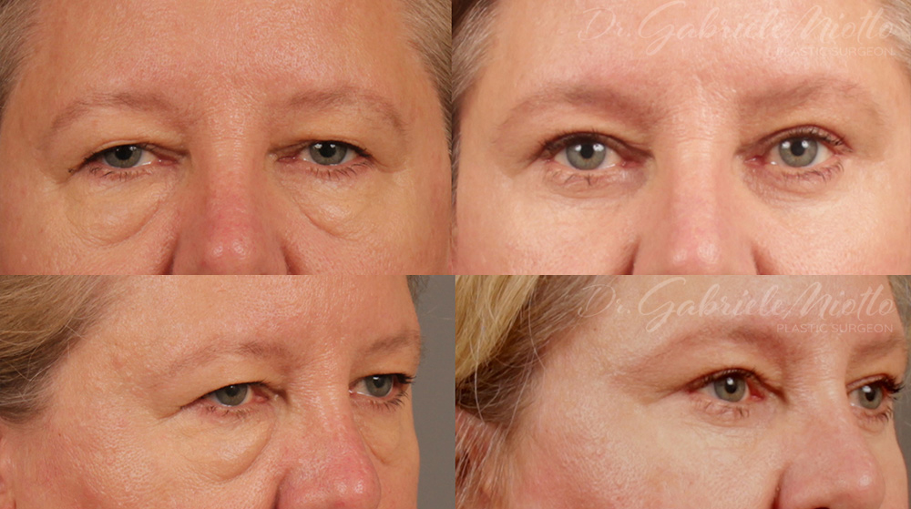 Upper & Lower Eyelid Surgery (Blepharoplasty) performed by Dr. Miotto