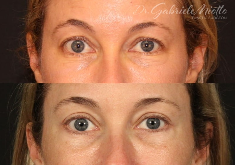 Eyelid Surgery (Blepharoplasty) Before & After Photo - Dr. Gabriele Miotto