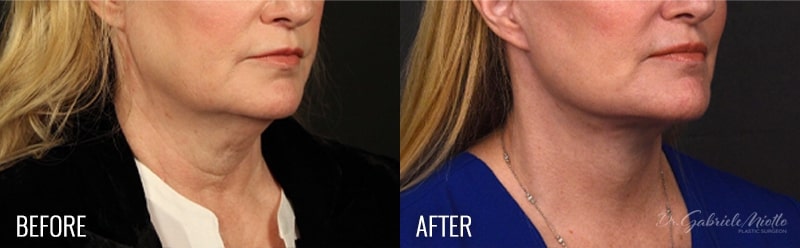Facelift Before and After Photo. Facelift Surgery performed in Atlanta, GA by Dr. Miotto