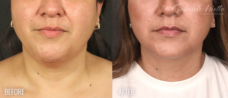 Facelift Before & After Photo - Dr. Gabriele Miotto