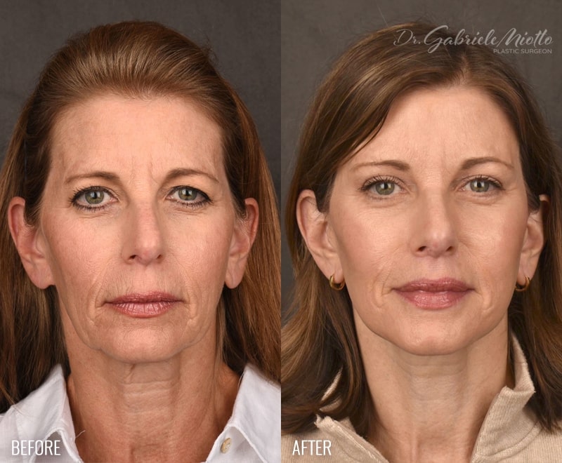 Facelift Before and After Photo. Facelift Surgery performed in Atlanta, GA by Dr. Miotto