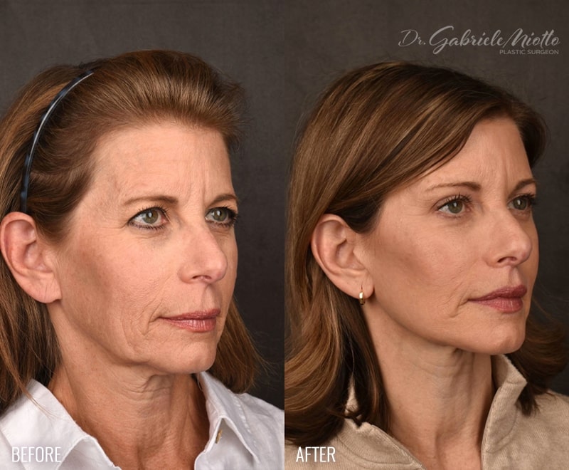 Facelift, neck lift, blepharoplasty, brow lift, lip lift and skin care