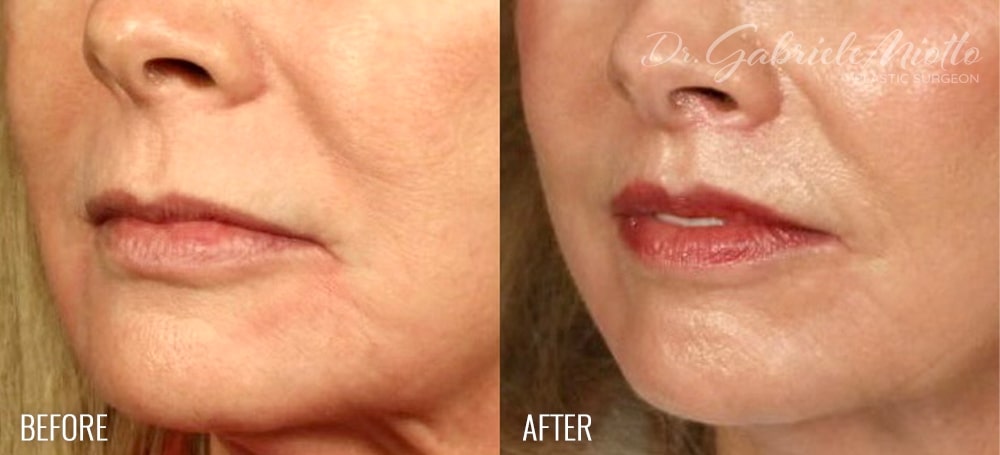 Lip Lift Before & After Photo - Dr. Gabriele Miotto