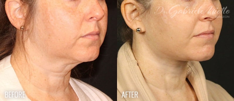 Neck Lift Before & After Photo - Dr. Gabriele Miotto