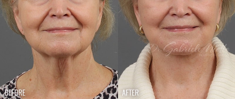 Neck Lift Before & After Photo - Dr. Gabriele Miotto