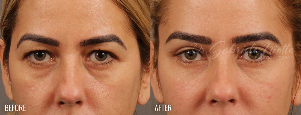 Brow Lift Before and After Photo. Surgery performed by Dr. Miotto in Atlanta, GA