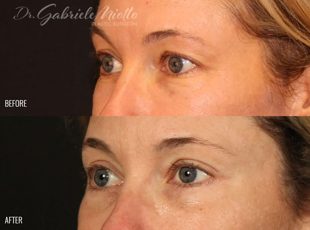 Brow Lift Before and After Photo. Surgery performed by Dr. Miotto in Atlanta, GA.