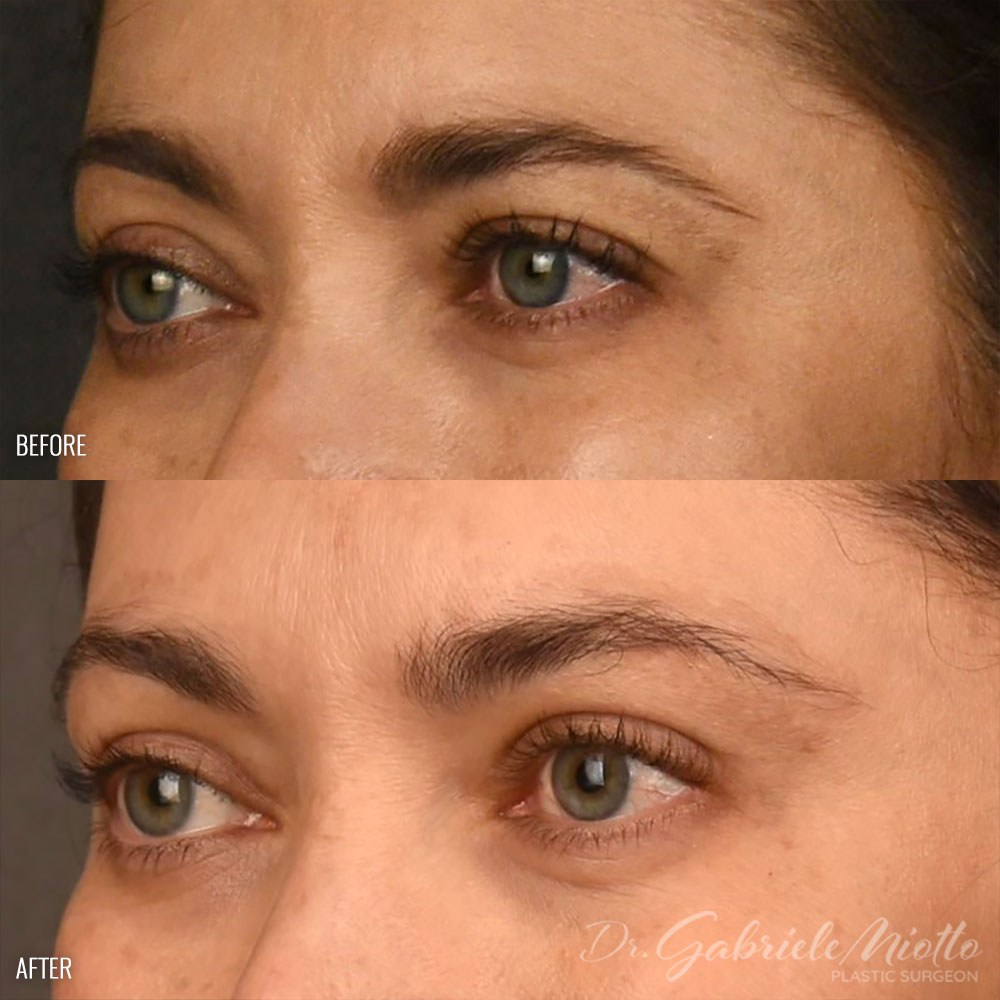 Brow Lift Before and After Photo. Surgery performed by Dr. Miotto in Atlanta, GA.