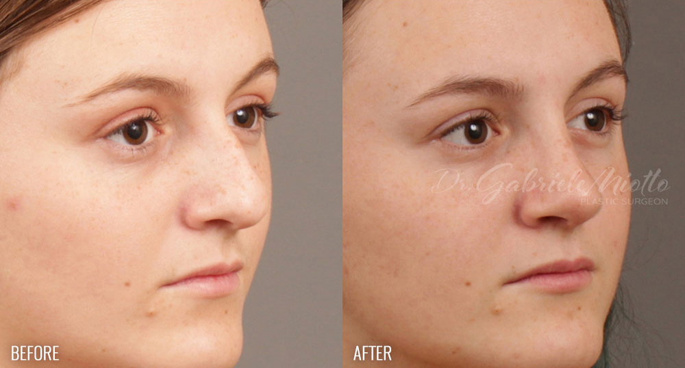 Rhinoplasty (Nose Job) Before and After Photo. Surgery performed by Dr. Miotto in Atlanta, GA.