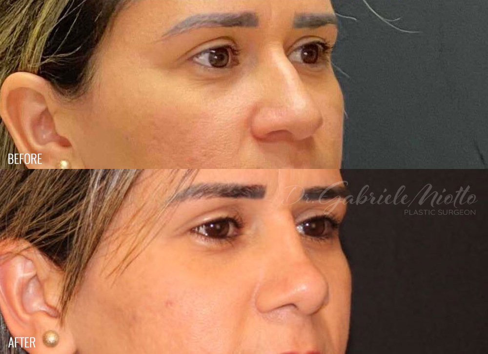 Rhinoplasty (Nose Job) Before and After Photo. Surgery performed by Dr. Miotto in Atlanta, GA.