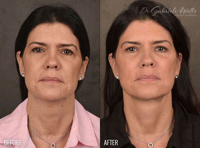Facelift Before & After Photo - Dr. Gabriele Miotto
