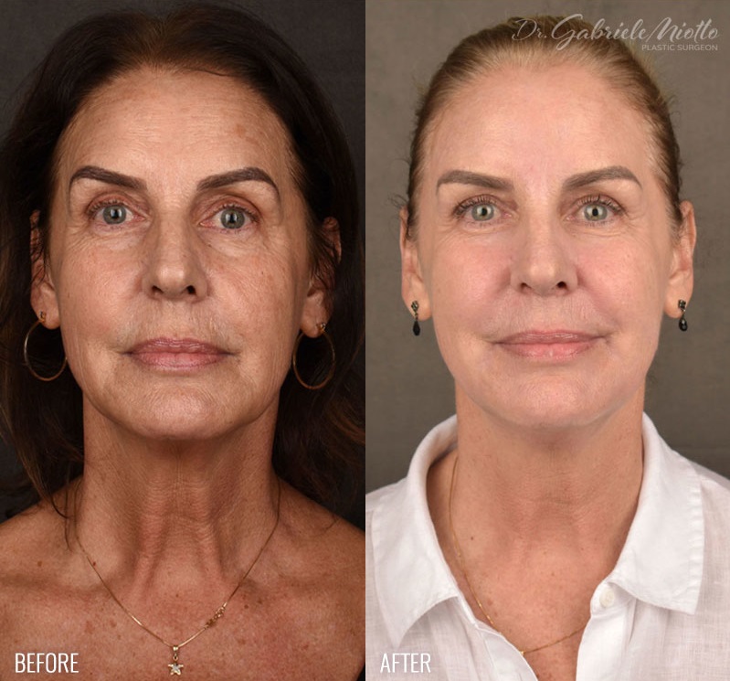 TCA Croton Peel Before and After Photo. Surgery performed by Dr. Miotto in Atlanta, GA.