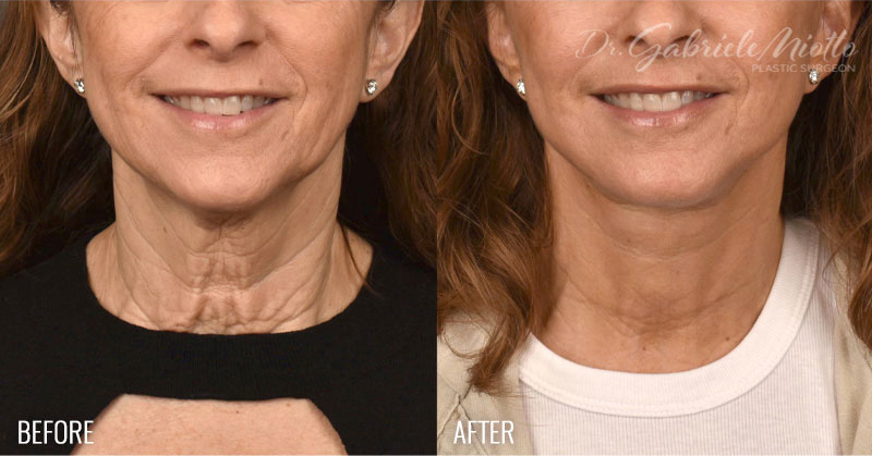 Neck Lift Before & After Photo - Dr. Gabriele 