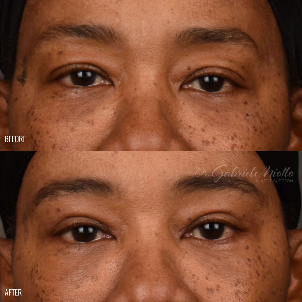 Eyelid Surgery (Blepharoplasty) Before & After Photo - Dr. Gabriele Miotto
