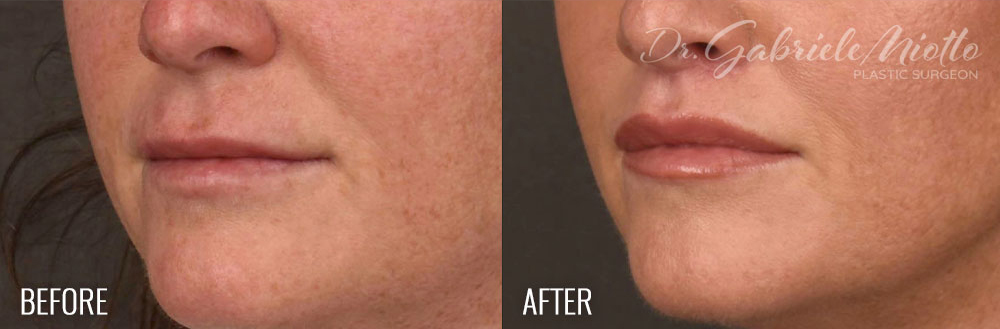 Lip Lift Before & After Photo - Dr. Gabriele Miotto