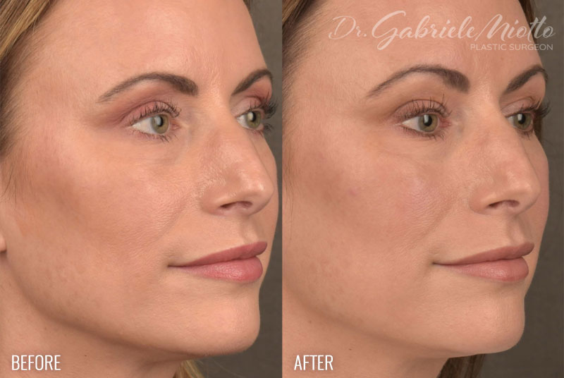 Facial Fat Grafting Before & After - Dr. Miotto