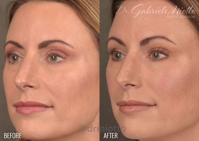 Facial Fat Grafting Before & After - Dr. Miotto