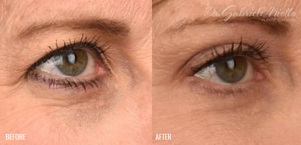 Eyelid Surgery (Blepharoplasty) performed by Dr. Miotto