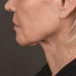 Neck Lift Before & After Patient #1081