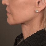 Neck Lift Before & After Patient #1081