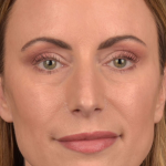 Facial Fat Grafting Before & After Patient #1250