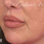 Lip Lift Before & After Patient #963