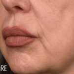 Lip Lift Before & After Patient #963