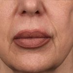 Lip Lift Before & After Patient #963