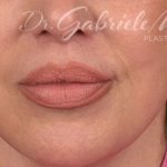 Lip Lift Before & After Patient #963