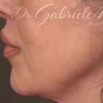 Lip Lift Before & After Patient #963