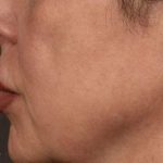 Lip Lift Before & After Patient #963