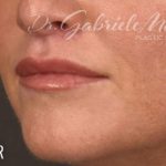 Lip Lift Before & After Patient #961