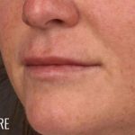 Lip Lift Before & After Patient #961