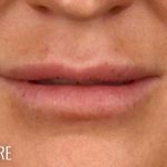 Lip Lift Before & After Patient #967