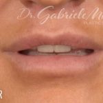 Lip Lift Before & After Patient #967