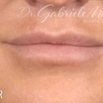 Lip Lift Before & After Patient #967